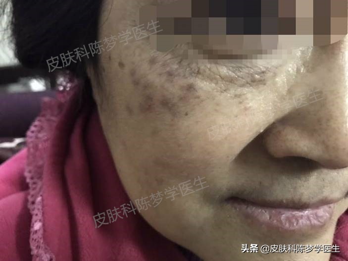 色斑和褐斑,根治面部黑褐斑的方法