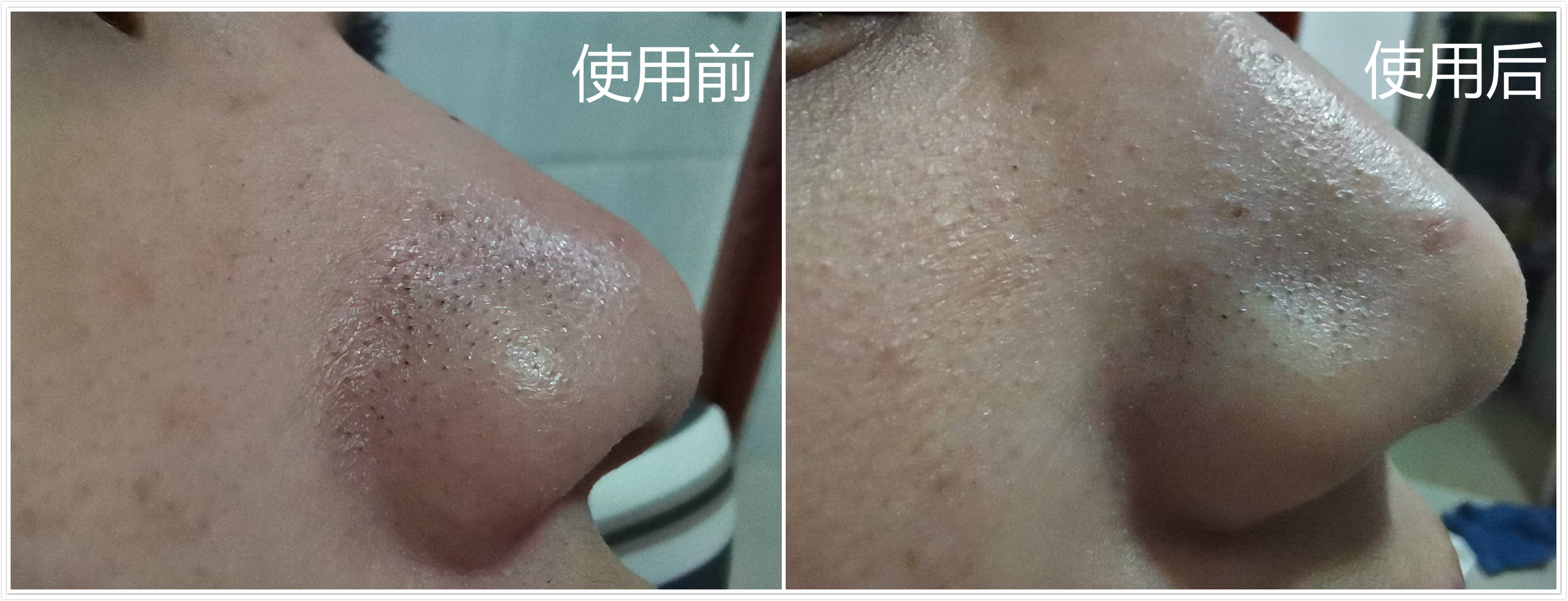 脸部黑头粉刺的最佳去除方法,脸上黑头粉刺用什么办法快速解决