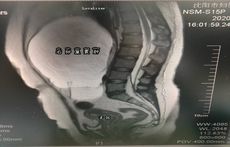 卵巢肿瘤新技术,卵巢恶性巨大肿瘤手术