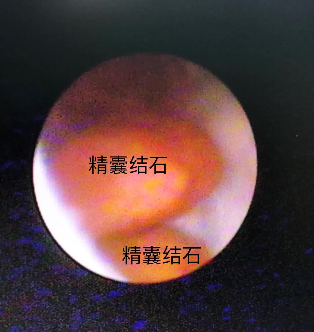 精囊结石精囊镜,精囊镜与钬激光手术