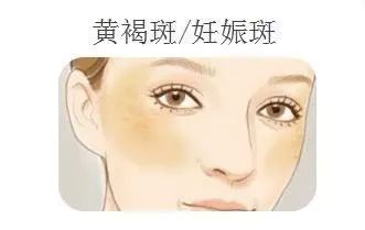 再美的脸，也抵挡不住“加斑”的困扰