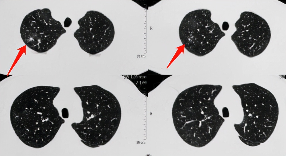 这种病菌1亿年前就有了，后来地球出现人类，它又学会了感染人肺