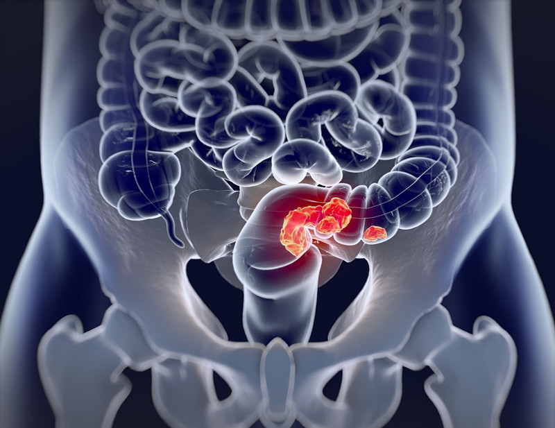 直肠癌保肛手术方案,放射治疗适合哪些直肠癌患者