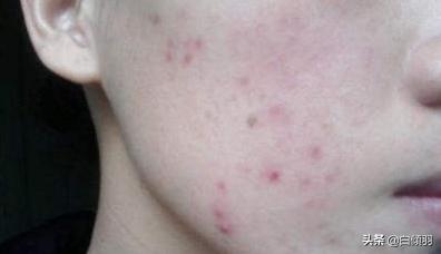 青春痘痘印痘疤怎么强力清除,脸上有痘印怎么办真实有效的方法