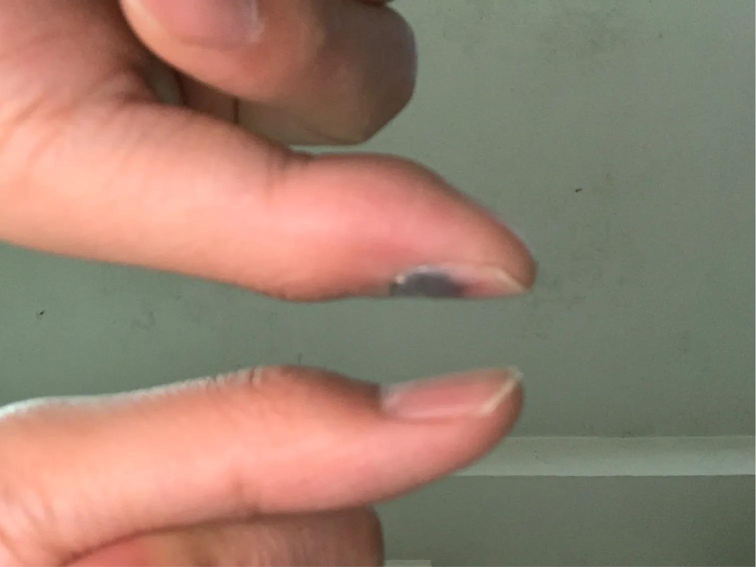 手指被夹出淤血该怎么办,手指被门夹淤血疼到睡不着