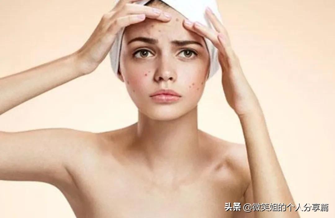 人中反复长痘，长闭口是怎么回事？