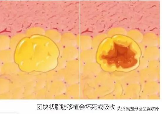 面部脂肪填充一个月皮肤的变化,面部脂肪填充的后脸部真的好了吗