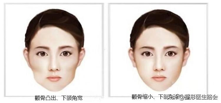 颧弓内推术颧骨磨骨,颧骨颧弓磨骨手术全过程