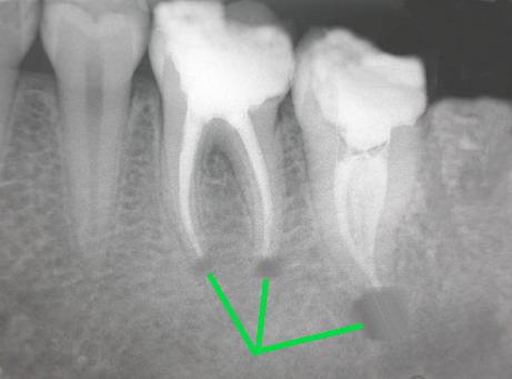 牙痛怎么办早期三大症状,请说出牙痛九个诱因