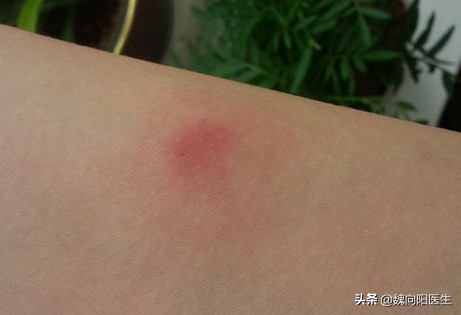 打碎伤风抗毒素过敏怎么办,猪用破伤风抗毒素过敏咋治