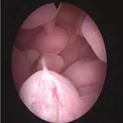 多年不孕容易长子宫肌瘤,多年不孕怎么找原因