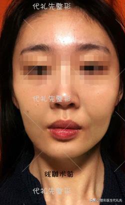 从整形医生的角度来聊一聊形成法令纹的原因以及改善方案