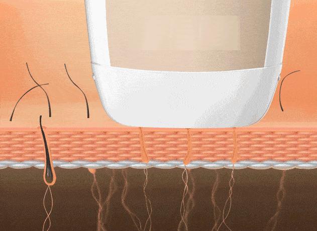 猕猴桃夏日脱毛,猕猴桃女孩轻松脱毛的救星