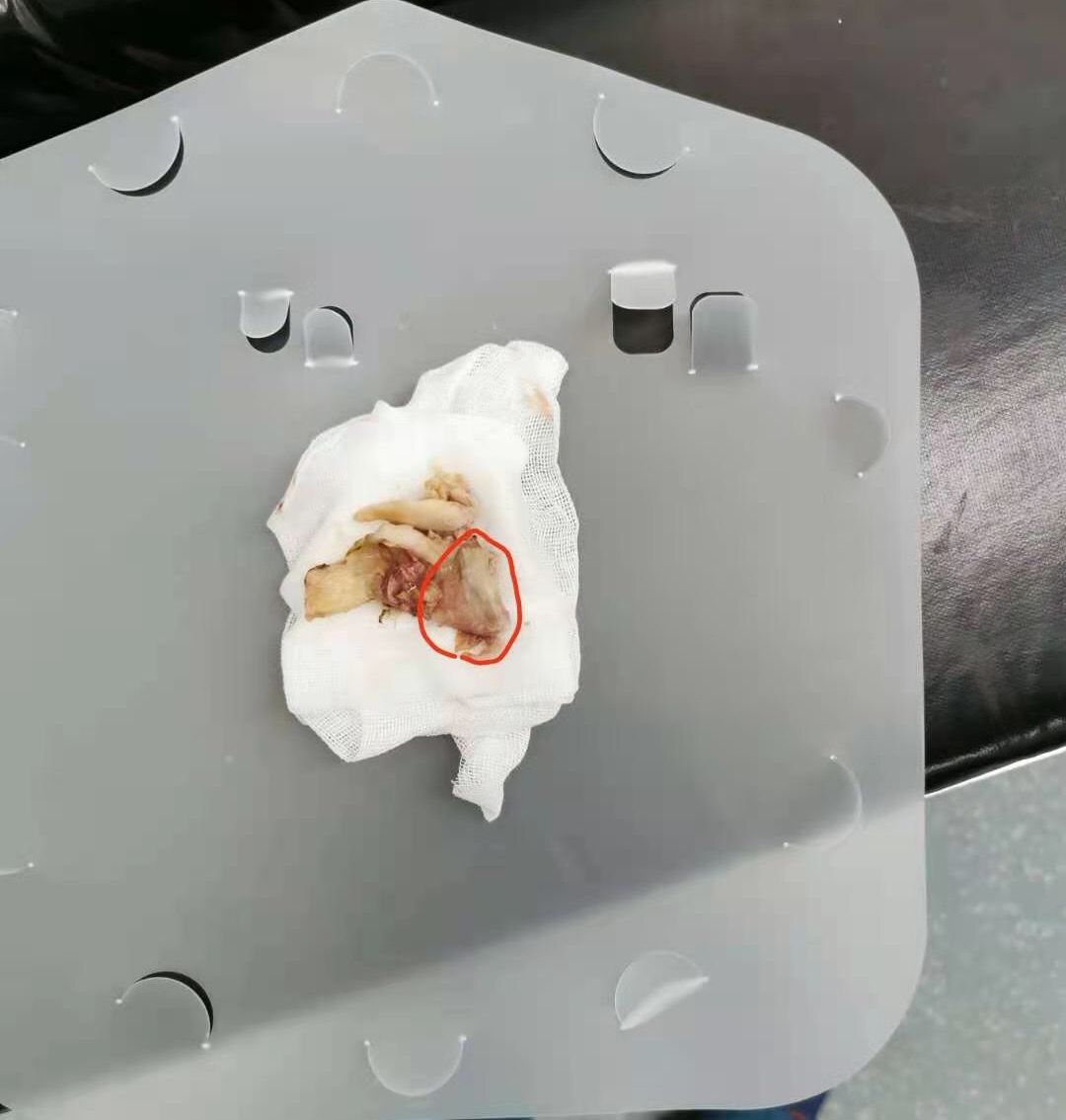 吃鸡骨头导致食道穿孔多久能好,吃骨头误吞导致食道穿孔