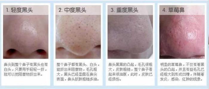 收缩毛孔10个最有效的方法,毛孔收缩真实有效的方法