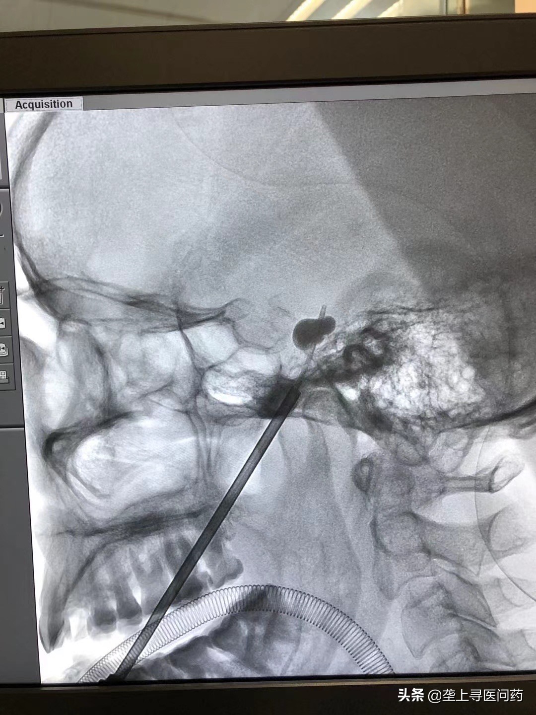 脸部神经疼了半个多月带着头顶痛,面部神经功能紊乱疼痛