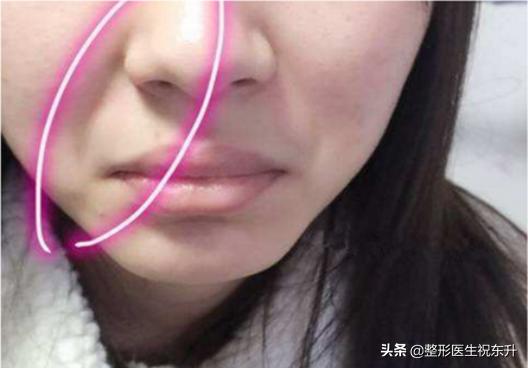 脸上的法令纹怎么去除,脸上有法令纹去除最好的方法