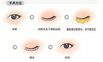 卧蚕和眼袋傻傻分不清的说说,眼袋卧蚕泪沟傻傻分不清楚