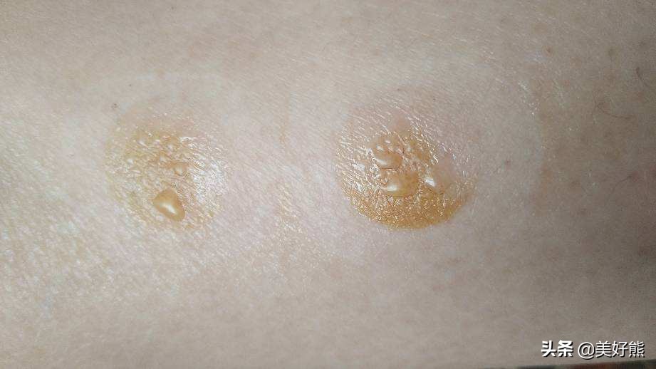 艾灸后的七大症状,艾灸灸着就睡着了好不好