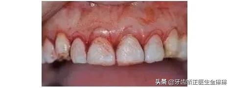 露龈笑对颜值有多大影响,颜值杀露龈笑