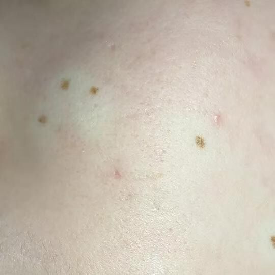 激光祛痣亲身经历和感受,激光祛痣亲身经历