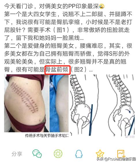 真翘臀和假翘臀怎么辨别,翘臀本来就有点骨盆前倾吗