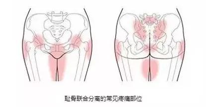 耻骨联合分离产后可以绑着睡觉吗,孕期耻骨联合分离缓解办法