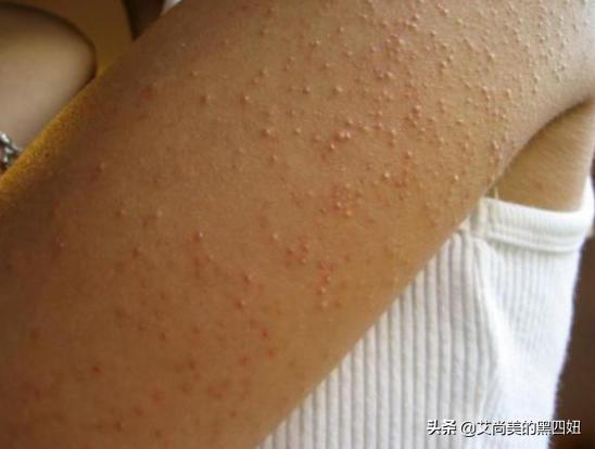 鸡皮肤怎么变白变嫩,如何去除鸡皮肤小窍门图解