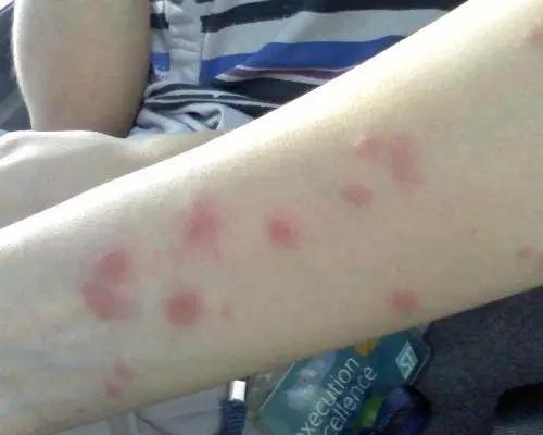 用什么土方法灭蚊子,有什么土办法灭蚊子