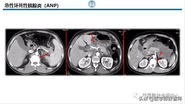 核磁ct都显示急性胰腺炎,急性坏死性胰腺炎的ct表现