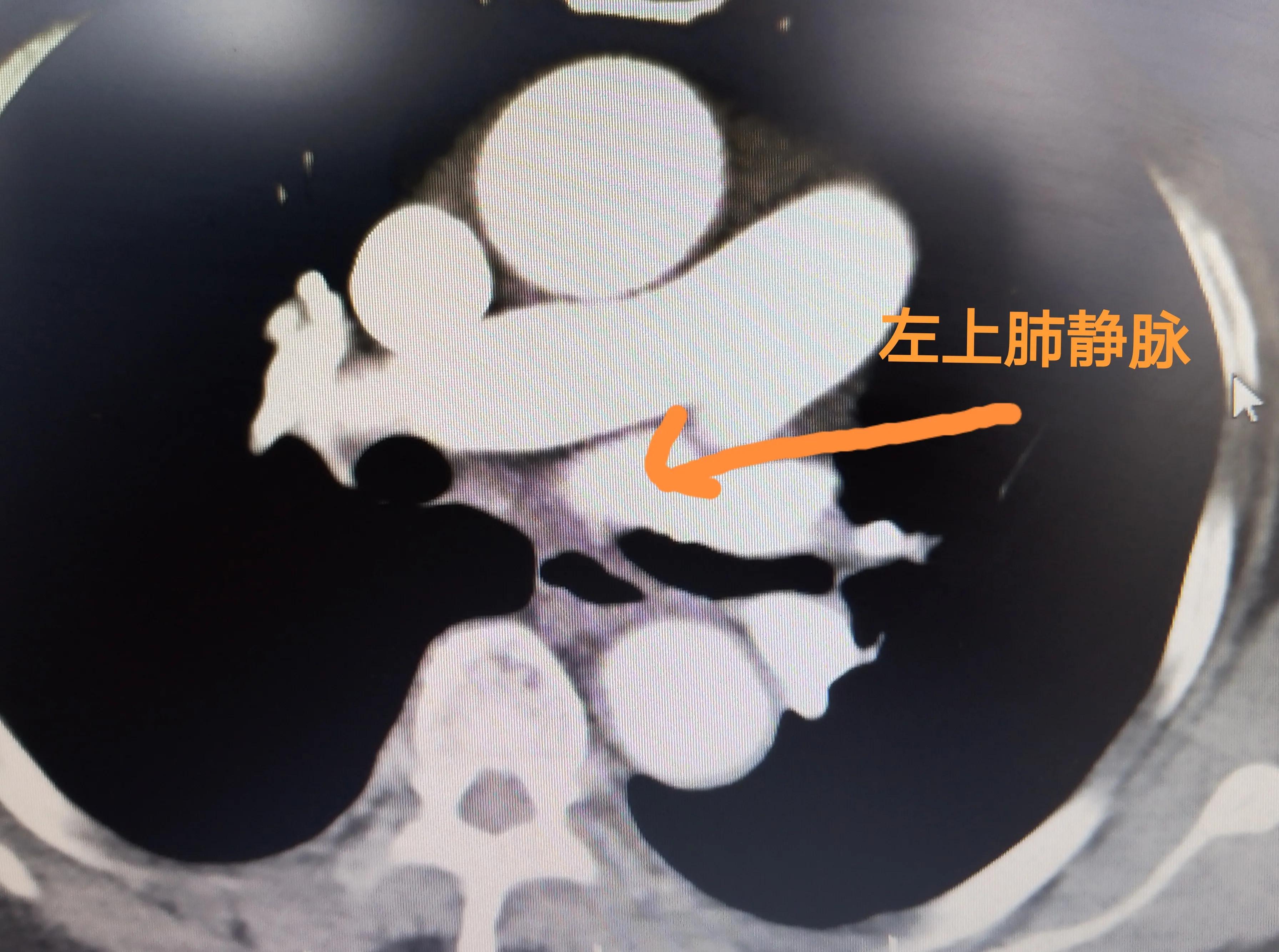 心血管病人吃伟哥,心血管病人可以用伟哥吗