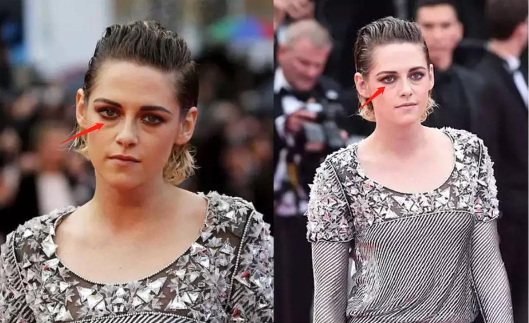 治眼袋三个小妙招快速去眼袋,上眼袋大最简单的去眼袋的方法