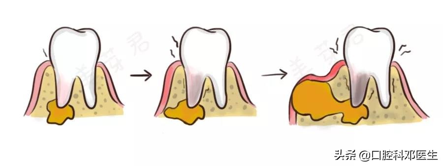 疫情后牙齿怎么修复好一点,肺炎期间能治牙吗