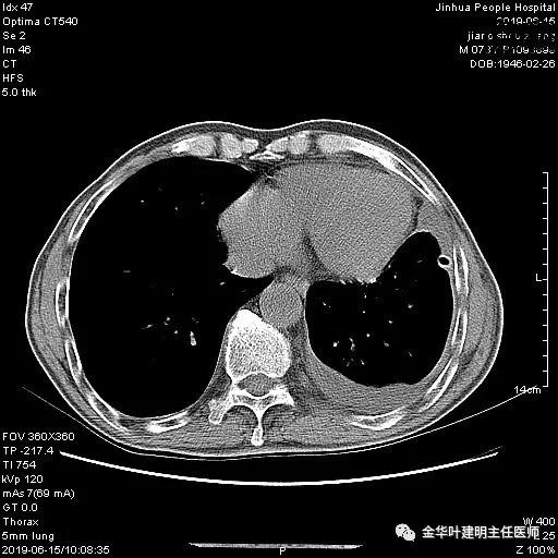 手术引起乳糜胸,有没有做了肺结节手术后是误诊的