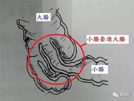 小儿肠套叠是什么原因发生的,小儿肠套叠有哪些症状表现