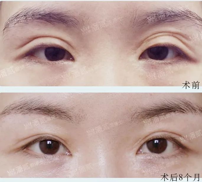 高难度双眼皮修复：那些被判死刑的失败双眼皮最后都怎样了？