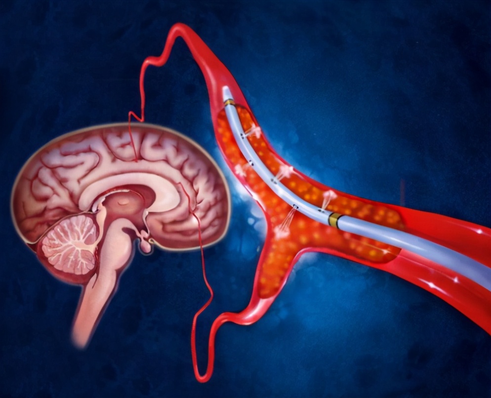 服用参松养心胶囊时期能吃萝卜吗,服用芪参益气滴丸