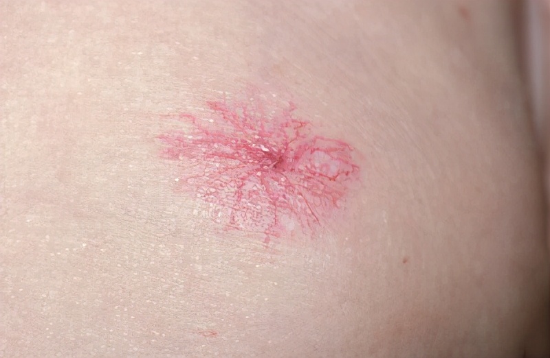 红痣是肝病的表现吗,长红痣是肝病的标志吗