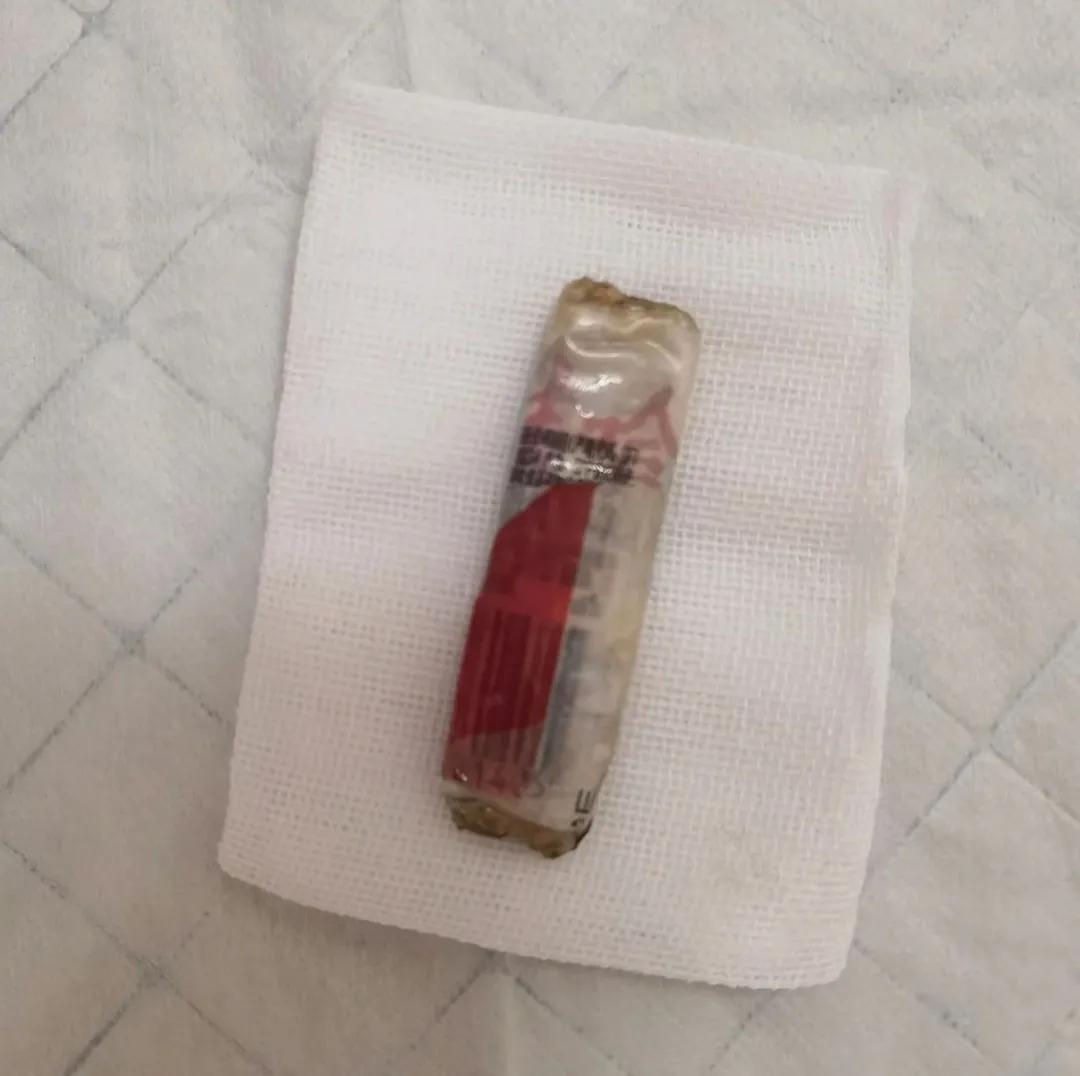 急诊内镜取异物,急诊喉咙取异物