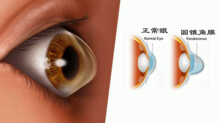 激光近视矫正手术有什么后遗症,激光矫正近视和散光有什么后遗症