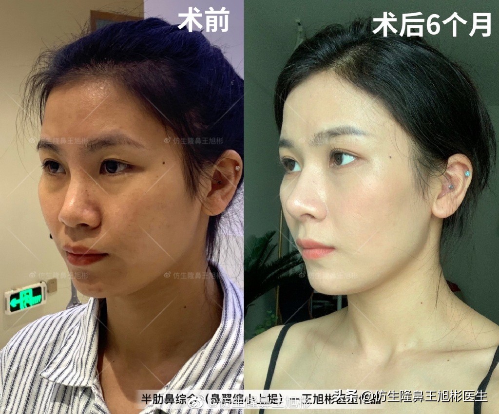 那些被鼻子“封印”颜值的鼻综合/修复案例|广州鼻整形