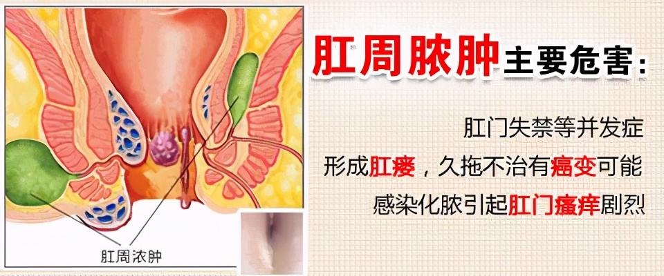 东大肛肠医院肛周脓肿怎么治,重庆东大肛肠医院肛周脓肿