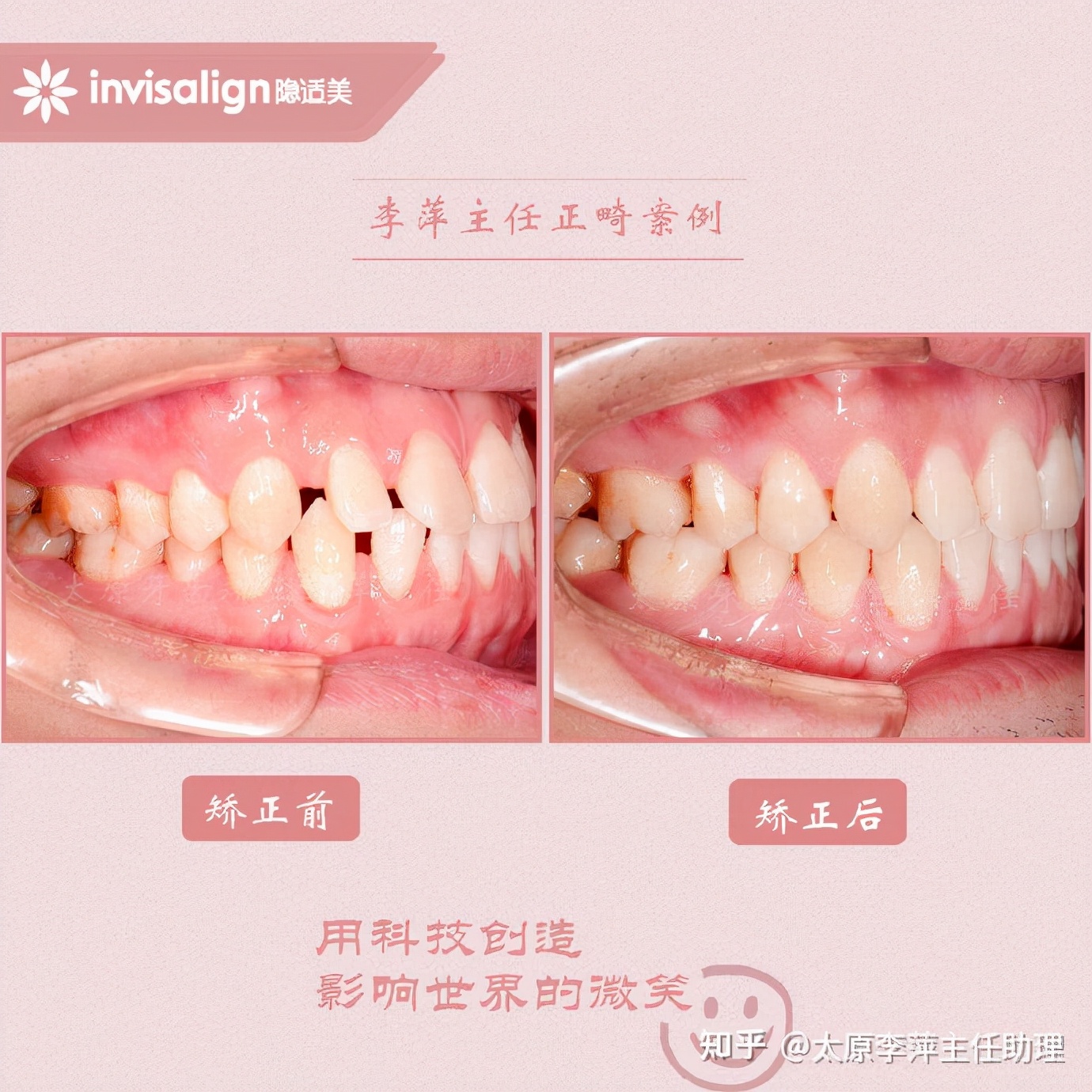 太原牙齿矫正靠谱吗,太原成人隐形牙套牙齿不齐