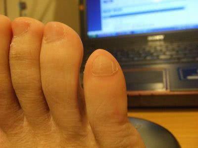 跑步趾甲瘀血原因,为什么跑步会黑脚趾甲