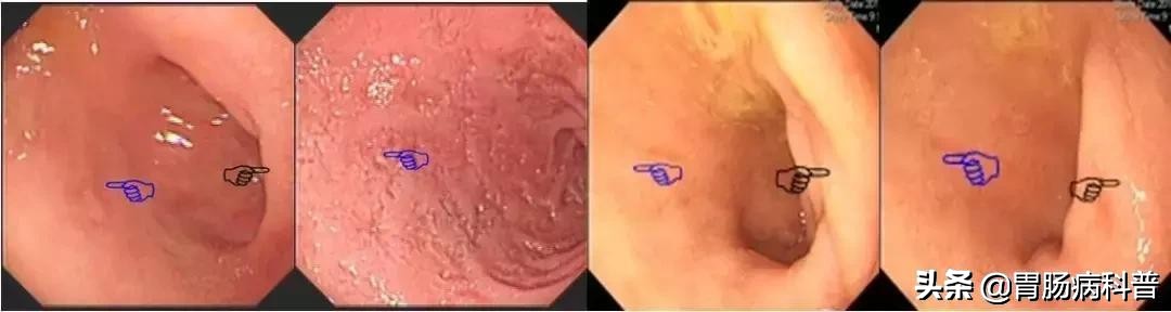 医生做胃镜检查时会看食道的吗,胃镜检查全过程视频消化内科检查