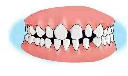 牙齿松动牙缝变宽最佳补救方法,牙齿松动牙缝越来越大是什么原因