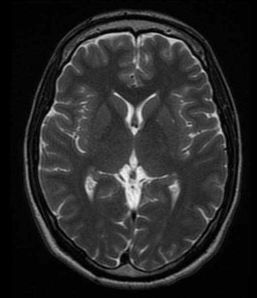磁共振怎么看大脑基底节区和丘脑,脑核磁能不能看清楚骨头