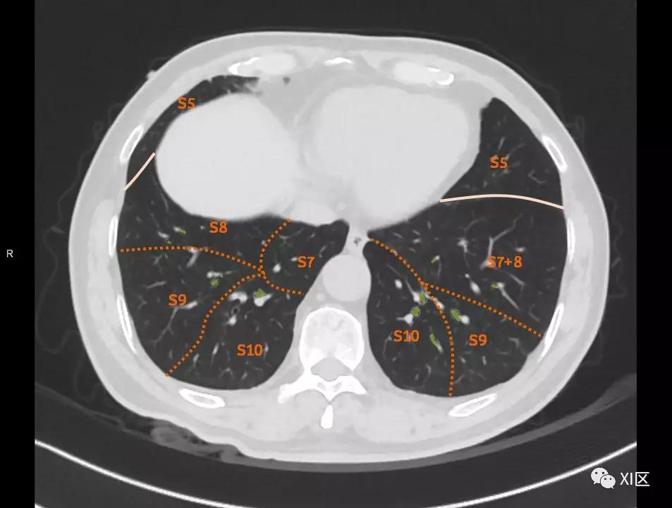 如此详细的肺部影像解剖，有点儿酷