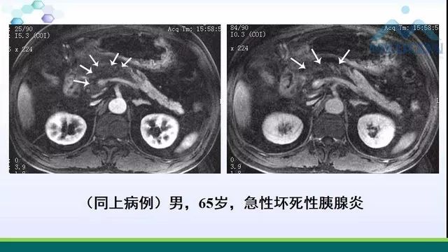 急性胰腺炎的护理措施,急性胰腺炎影像与临床