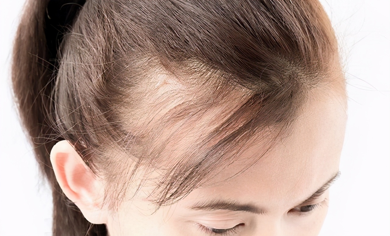 脱发的正确治疗方法和注意事项,脱发的常见类型与防治